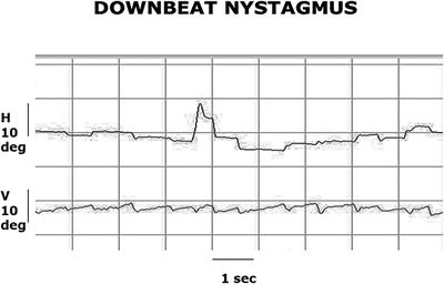 Case report: Acute vestibular syndrome and cerebellitis in anti-Yo paraneoplastic syndrome